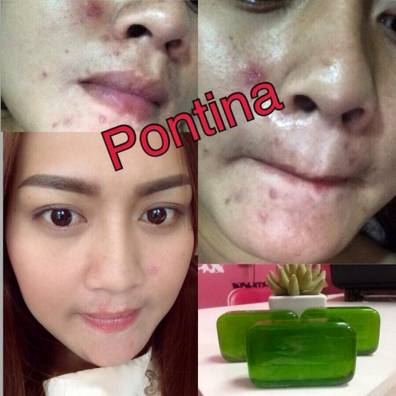 ร้าน สบู่รักษาสิว พรทินาปลีก-ส่ง