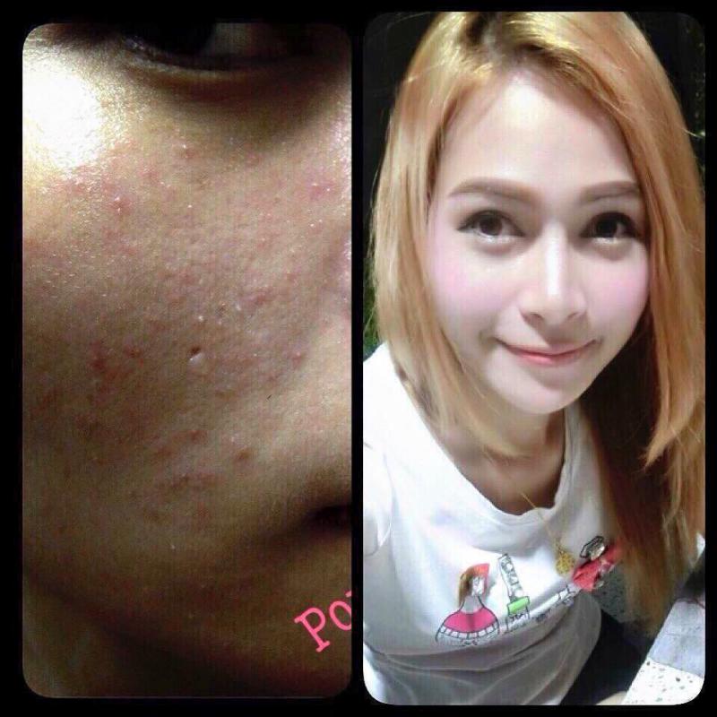 ร้าน สบู่รักษาสิว พรทินาปลีก-ส่ง