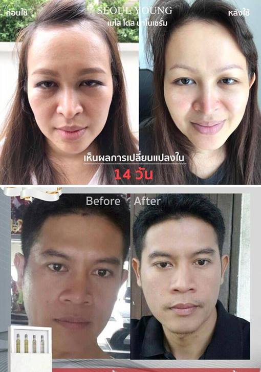 เมโส โดส ไร้หัวเข็ม เจ้าแรกในเมืองไทย! จาก โซล ยัง สกิน แคร์ ปลอดภัย 100% ฟื้นฟูผิวหน้าเร่งด่วน ผิวอ่อนวัย แพ้ง่ายก็ใช้ได้ ด่วน!ราคาพิเศษ